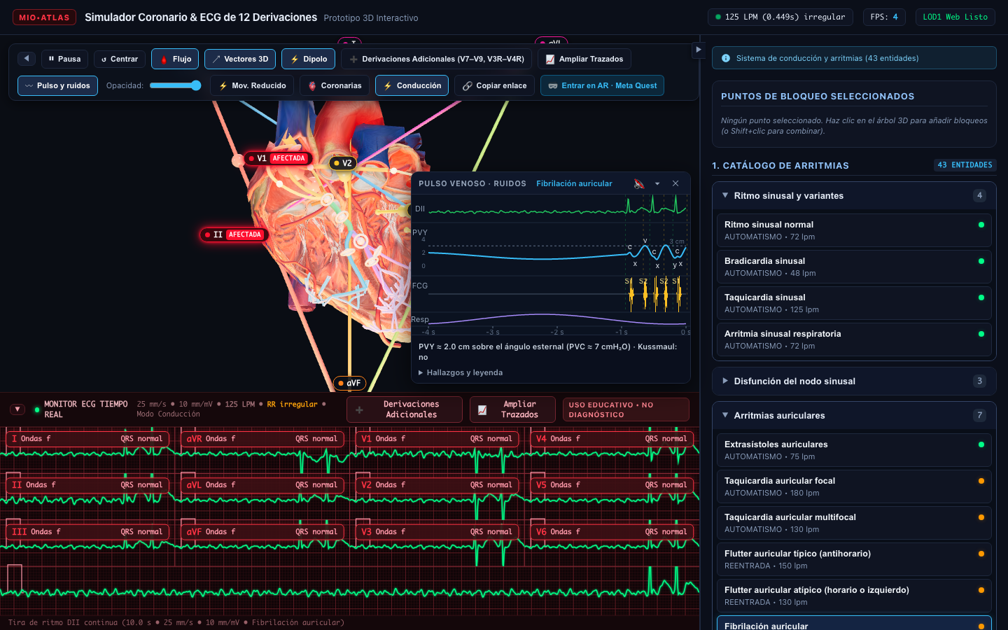 Simulación del sistema de excito-conducción y fibrilación auricular en corte coronal 3D