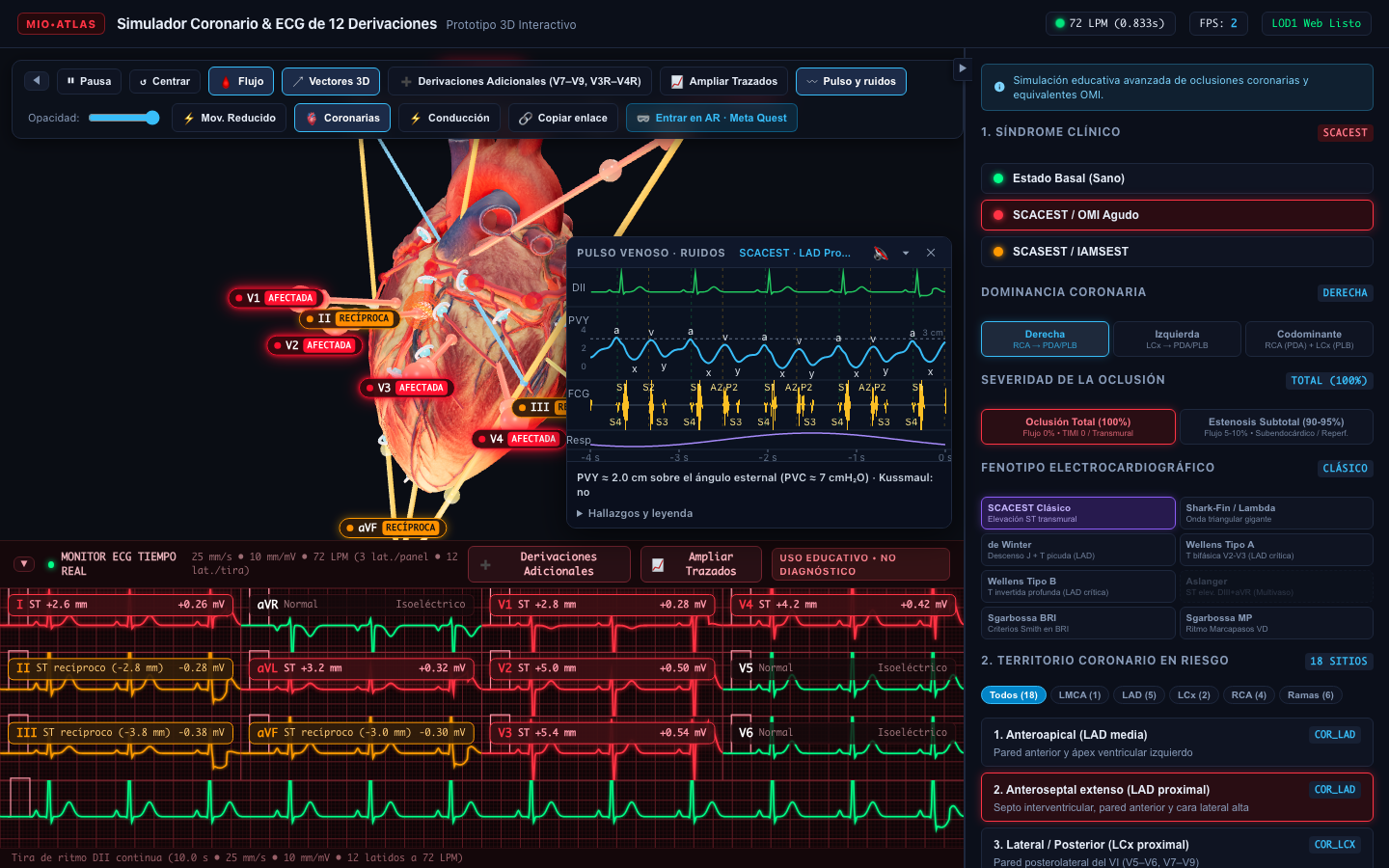 Simulación 3D de infarto SCACEST por oclusión proximal de la arteria descendente anterior con elevación del ST